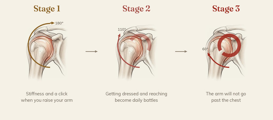 The stages of a freezing shoulder, range of motion shrinking step by step